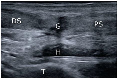 JCM | Free Full-Text | Mini-Invasive, Ultrasound Guided Repair of the Achilles Tendon Rupture—A ...