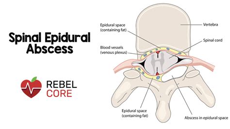 Spinal Epidural Abscess (SEA) - REBEL EM - Emergency Medicine Blog