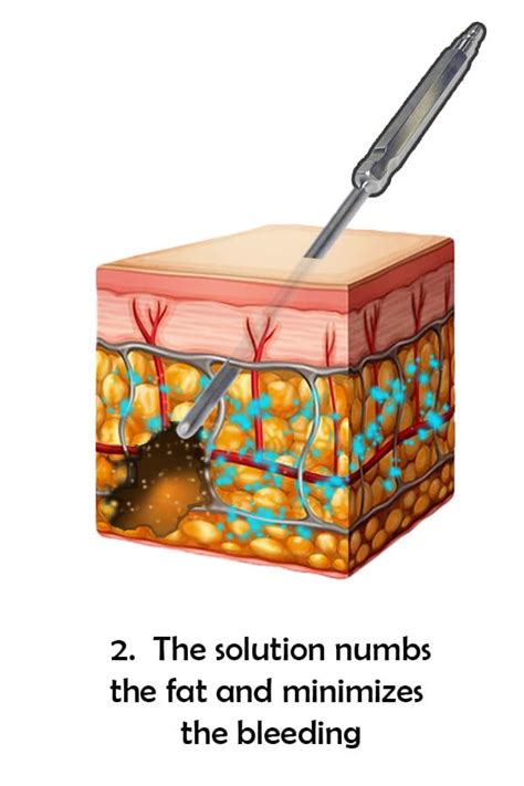 Tumescent Liposuction Orlando - Orlando Liposuction Specialty Clinic