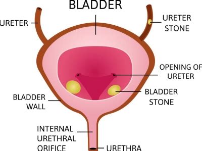 Bladder Stones Treatment in Nagpur : Dr. Chaitanya Deshmukh