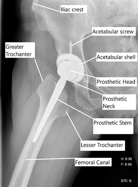 Minimally Invasive Total Hip Replacement | Complete Orthopedics