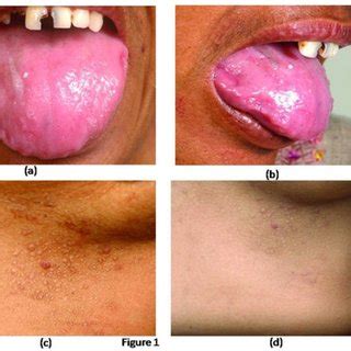 (PDF) Skin Involvement in Primary Systemic Amyloidosis