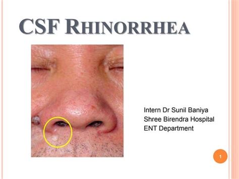 Csf Rhinorrhea - Overview