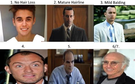 The Mature Hairline Explained - Are You Balding or Maturing?