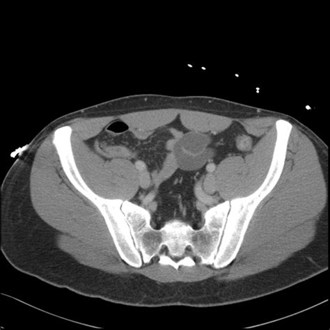 Muscles Of Pelvis Ct Anatomy