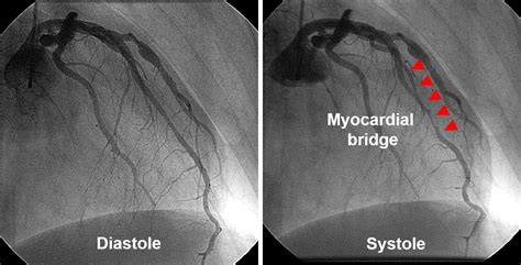 Impact of Myocardial Bridge on Life‐Threatening Ventricular Arrhythmia ...