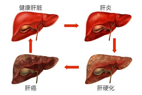 为什么肝癌一发现就是晚期？原因在这里！_投保攻略-开心保保险网