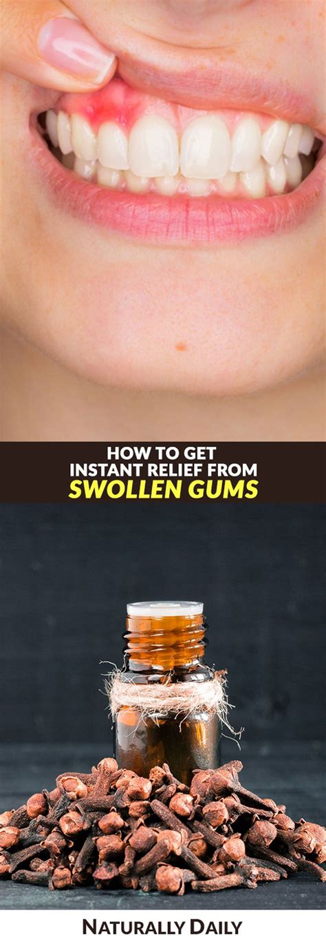 11 Home Remedies for Swollen Gums for Instant Relief| Swollen gums are ...