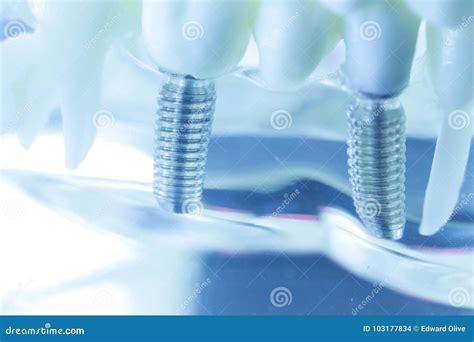 Dental Titanium Tooth Implant Stock Photo - Image of model, prosthesis: 103177834