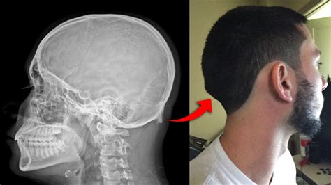 Where does the ‘occipital torus’ protrusion on some people’s heads come from? | Div Bracket