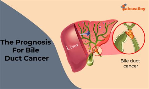 The Prognosis For Bile Duct Cancer