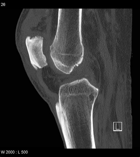 Quadriceps Tendon Calcification