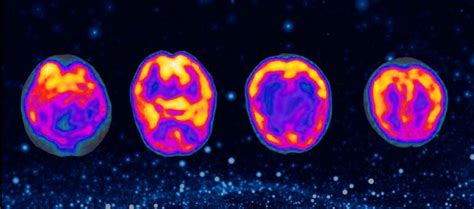 fMRI vs. SPECT Scan for the Brain | Cognitive FX