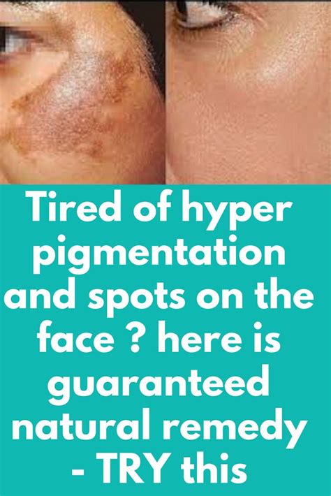 Tired of hyper pigmentation and spots on the face ? here is guaranteed ...