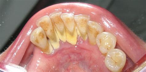 Calculus Bridge: Causes, Symptoms, Prevention and Removal - YeyeLife