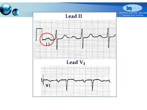 CVT Mohd Farid: Basic ECG Part III-P Wave & PR Interval