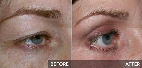 How Plexr non surgical eye lift has revolutionised eye lift surgery