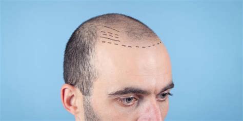 Which is the Best Doctor for a Hair Transplant in Delhi? : r/Hairtransplant