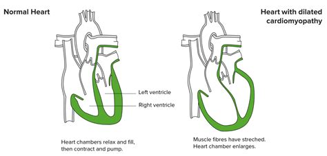 Cardiomyopathy (Heart Muscle Disease) — Symptoms and Causes