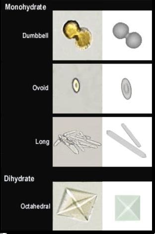 Calcium Oxalate Monohydrate Crystals In Urine