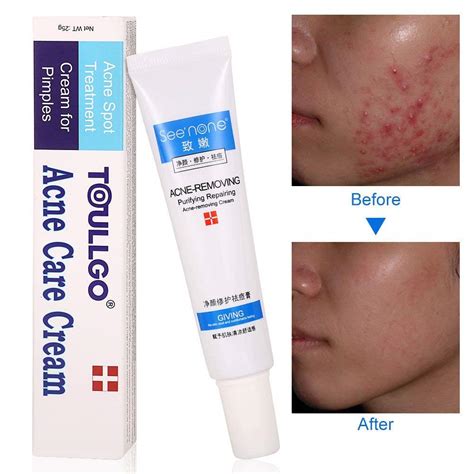 Best Topical Treatment For Fungal Acne at Gary Fearon blog