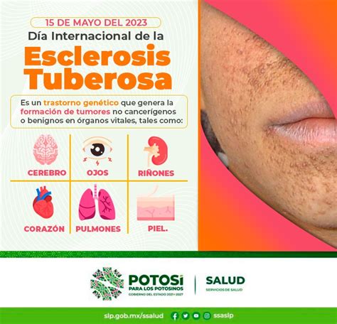 Esclerosis tuberosa enfermedad en uno de cada 6 mil habitantes – EOS Noticias