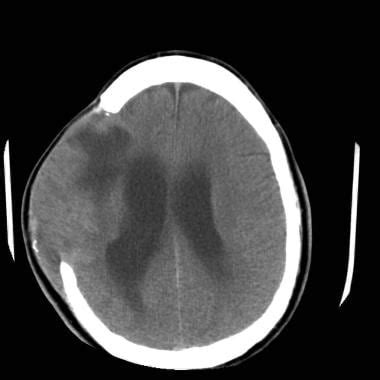 Brain Herniation Imaging: Overview, Computed Tomography, Magnetic ...