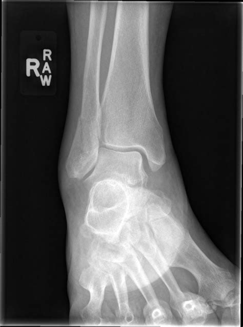 DISTAL FIBULA FRACTURE | Buyxraysonline