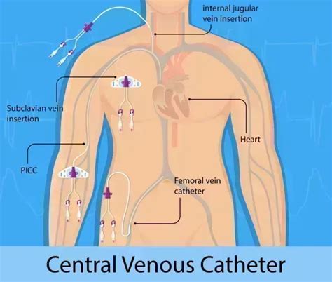 Identify Type of Arrhythmia to Choose Correct Ablation Code : You Be ...