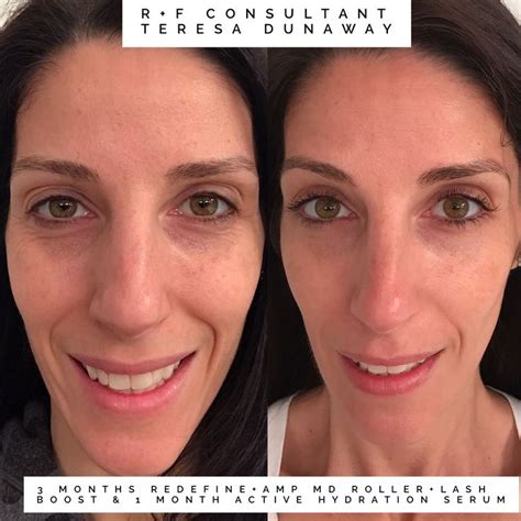 I thought my skin was pretty good to start with. I am amazed with my before+after! *Redefine Am ...