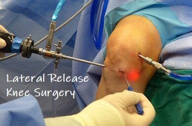 Lateral release knee surgery realigns the patella by releasing tight structures on the outer ...