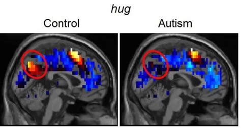 Brain Representations of Social Thoughts Accurately Predict Autism ...