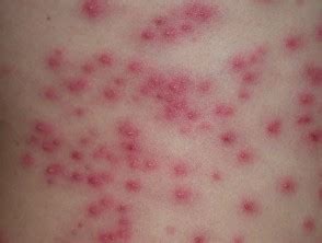 Pseudomonas skin infections | DermNet NZ