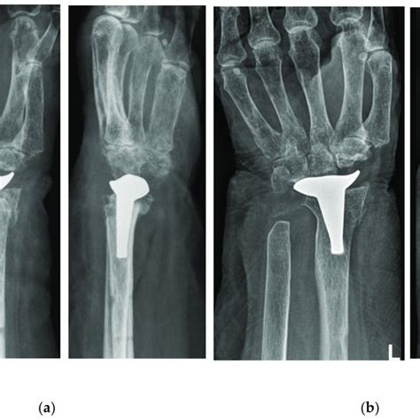 X-rays in posterior-anterior (left) and lateral (right) view after the ...