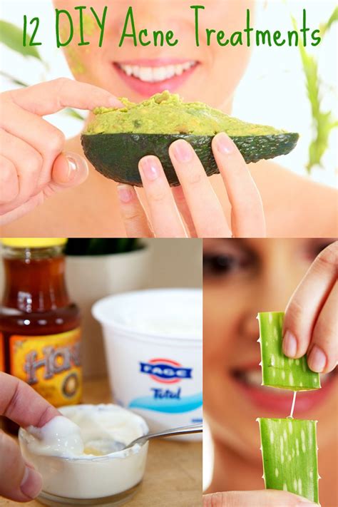 12 DIY Acne Treatments That Will Save Both Your Money And Your Skin ...