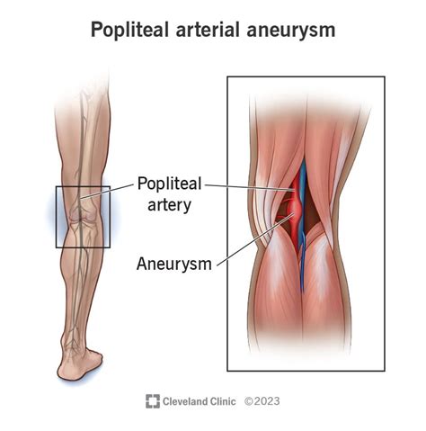 Popliteal Aneurysm: Symptoms & Treatment