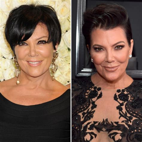 Celebrity Facelifts and Plastic Surgery: See Then-and-Now Pics