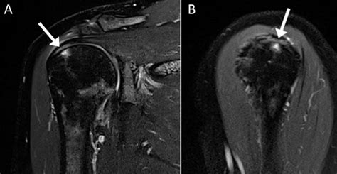 Supraspinatus Partial Tear Mri