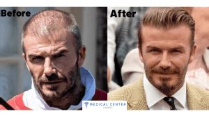 David Beckham's Hair Transplantation - MCT