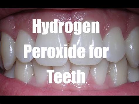 Peroxide For Teeth