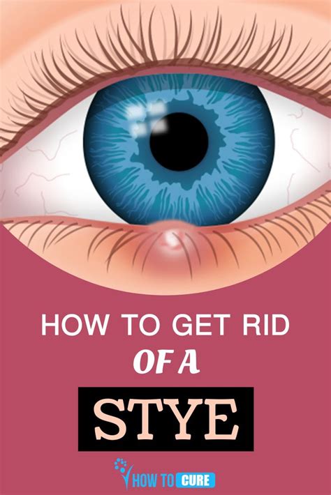 Natural Remedies to Cure Stye at Home | Eye stye remedies, Stye remedy ...