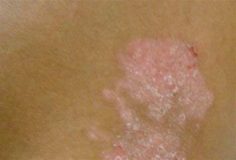 8 Penyakit Kulit Psoriasis, Gejala, Penyebab & Cara Mengatasi