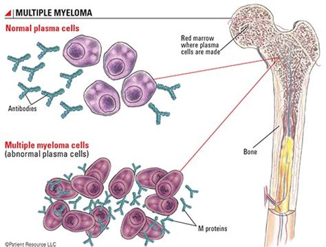 Autologous Stem Cell Transplant Show NO OVERALL SURVIVAL for Myeloma ...