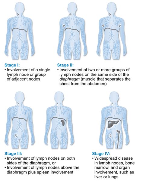 Staging and Prognosis | Lymphoma Research Foundation