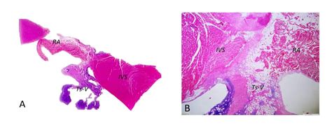 Interventricular Septum Histology