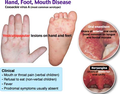 Hand Foot And Mouth Disease In Mouth