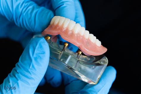 Snap In Dentures: Everything You Need to Know About Overdentures