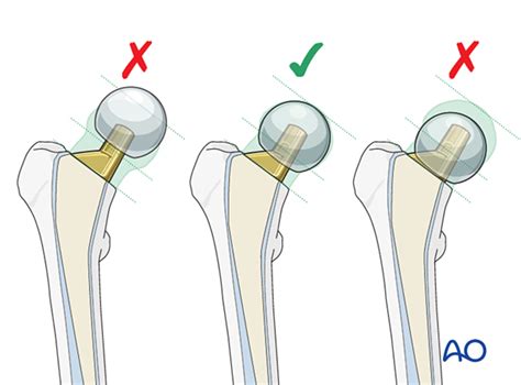 Hemiarthroplasty For Femoral Neck And Head Fractures With, 57% OFF