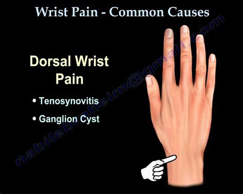 Top Of Wrist Pain Factory Wholesale, Save 58% | jlcatj.gob.mx