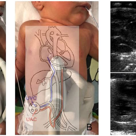 | Proper UVC (A) and UAC (B) imaging and positioning. The UVC leaving... | Download Scientific ...